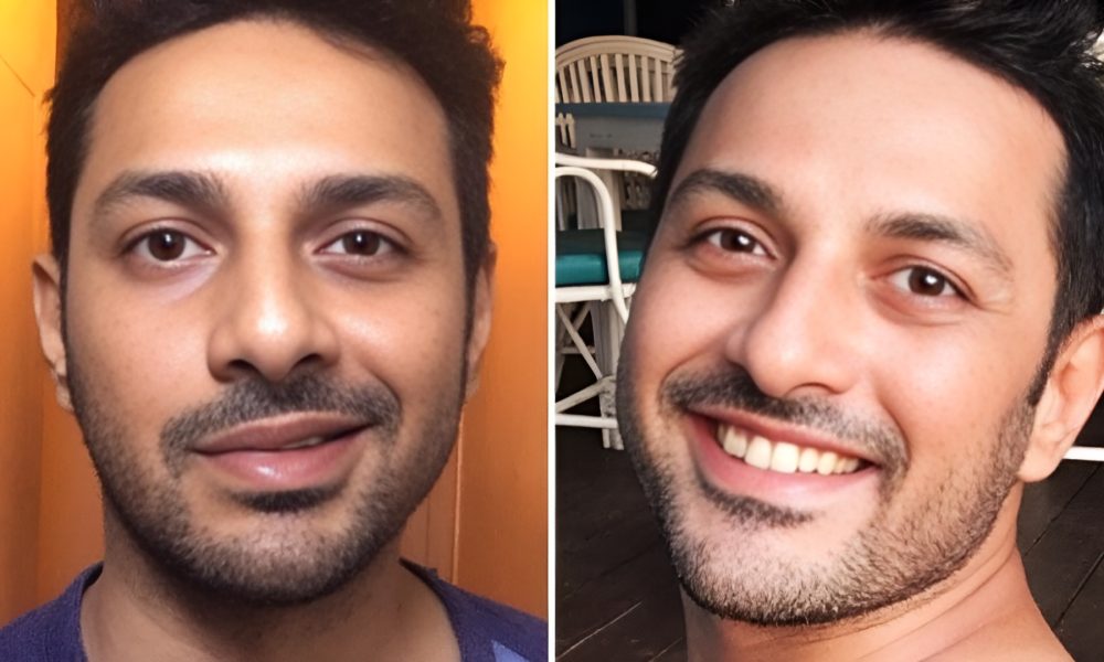 bell-s-palsy-treatment-services-Picsart-AiImageEnhancer