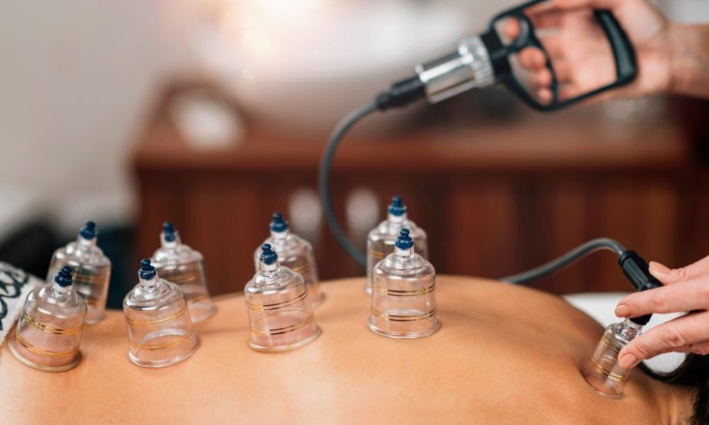 Cupping therapy - traditional Chinese medicine