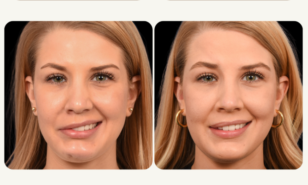 Bell’s Palsy